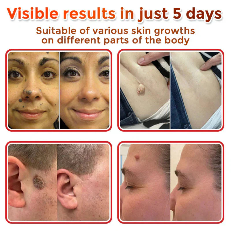 š MicroNeedle Botanic Skin Tag Removal Patch (Made in the USA)
