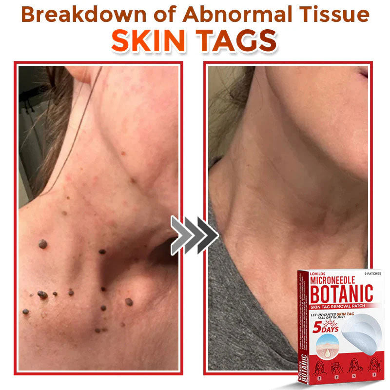 š MicroNeedle Botanic Skin Tag Removal Patch (Made in the USA)