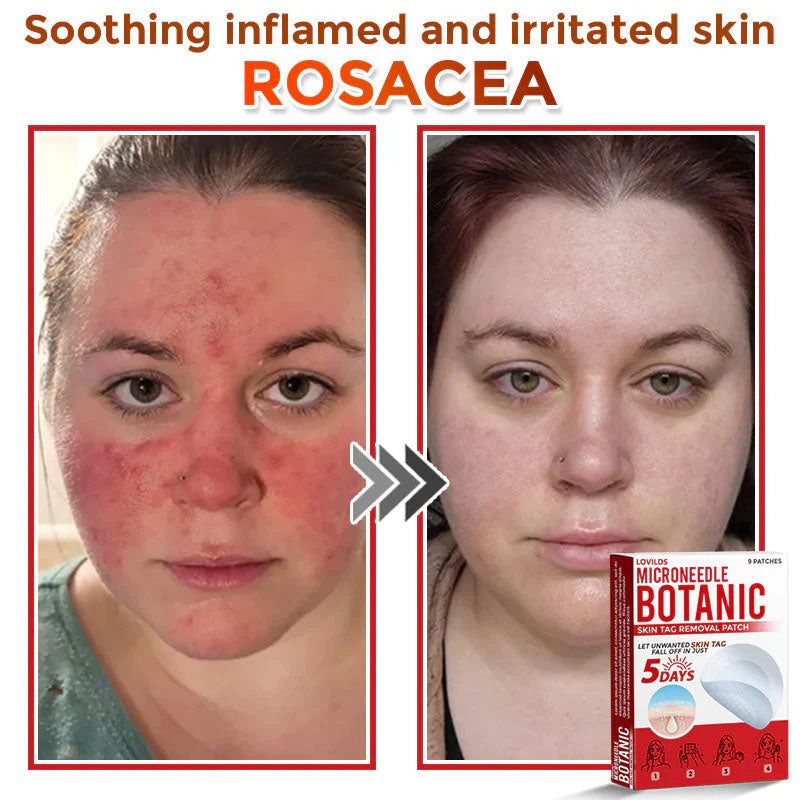 š MicroNeedle Botanic Skin Tag Removal Patch (Made in the USA)