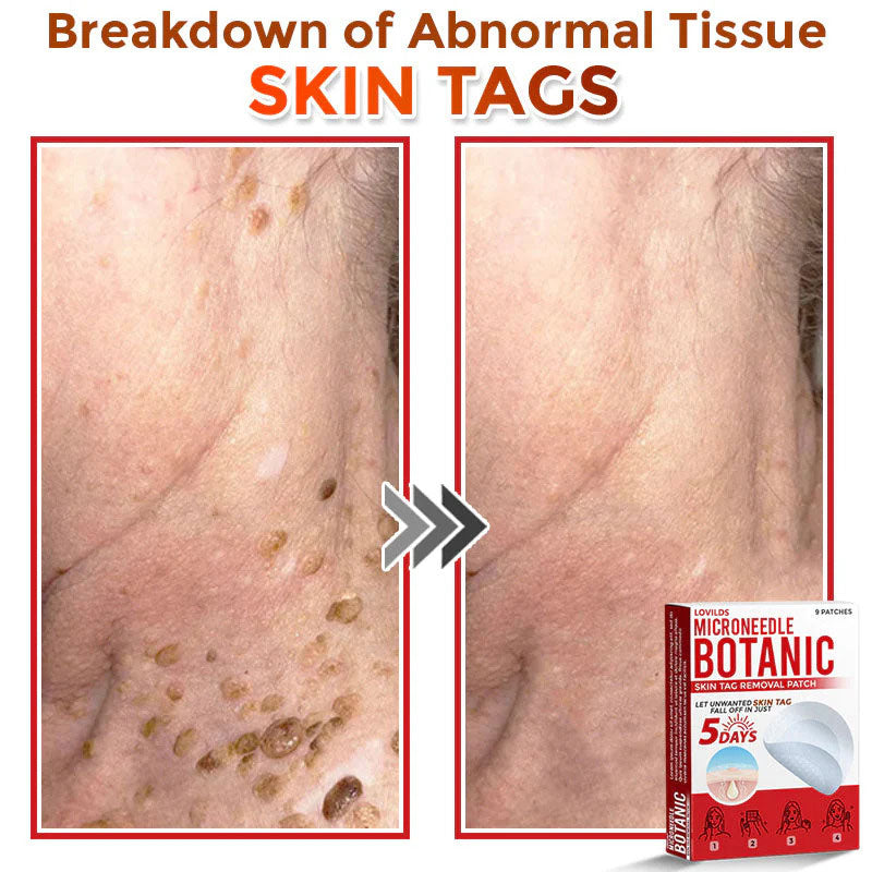 š MicroNeedle Botanic Skin Tag Removal Patch (Made in the USA)