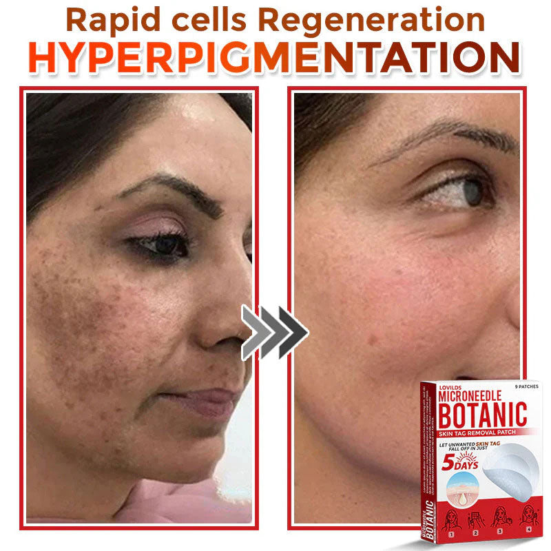 š MicroNeedle Botanic Skin Tag Removal Patch (Made in the USA)