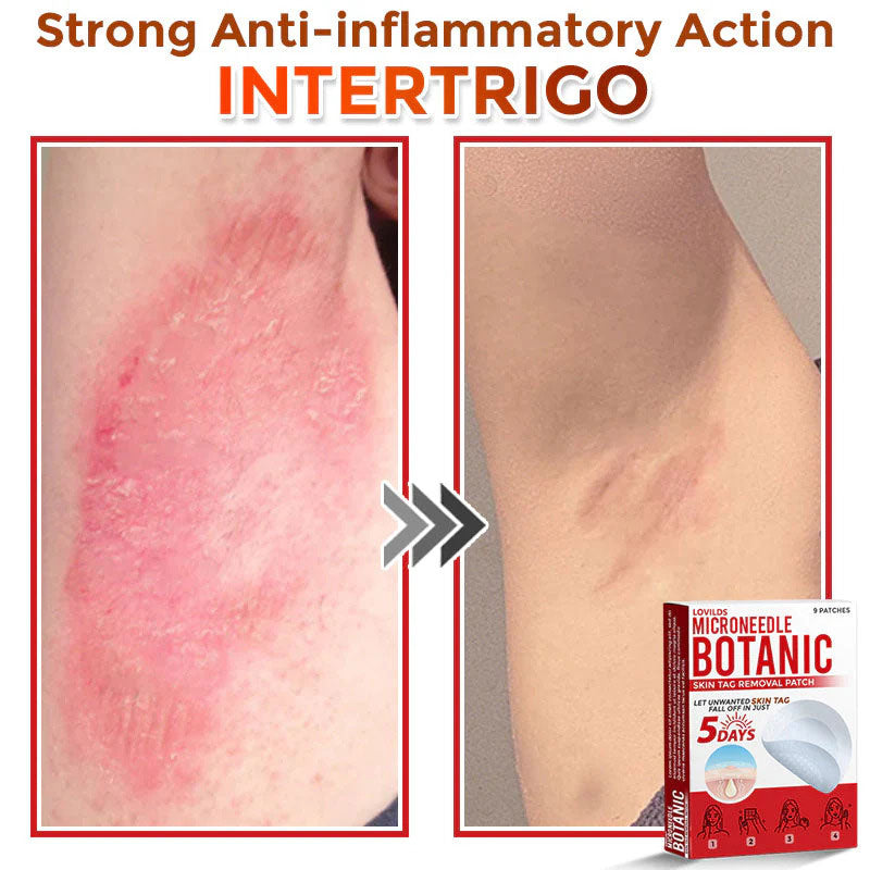 š MicroNeedle Botanic Skin Tag Removal Patch (Made in the USA)