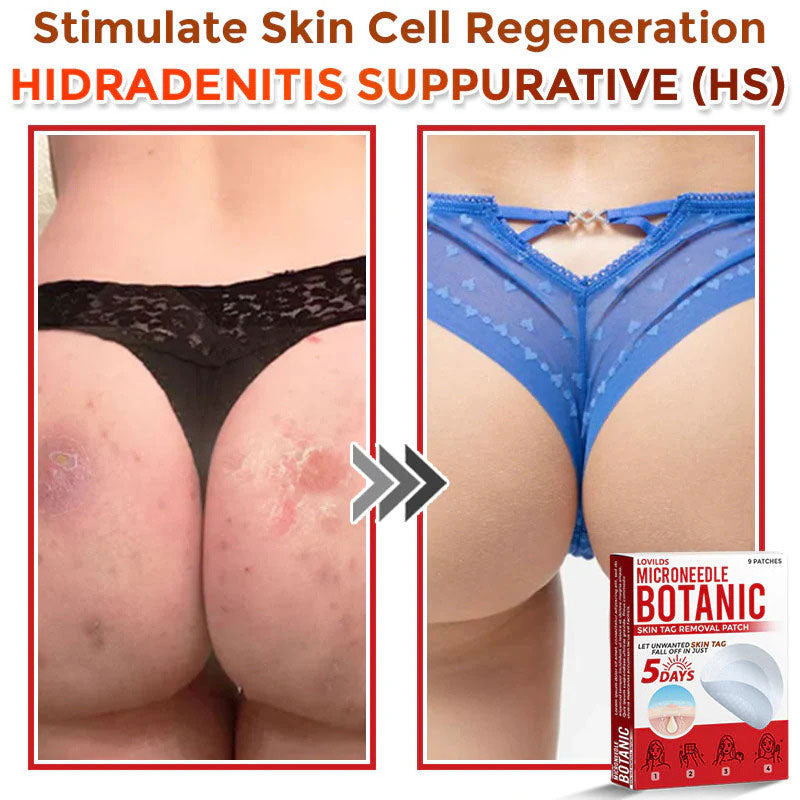 š MicroNeedle Botanic Skin Tag Removal Patch (Made in the USA)