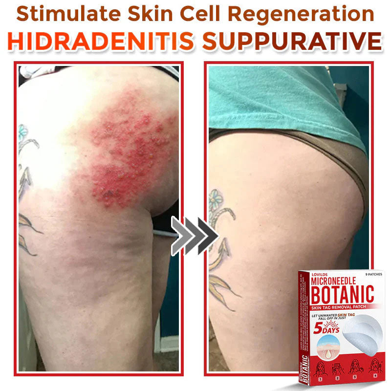 š MicroNeedle Botanic Skin Tag Removal Patch (Made in the USA)