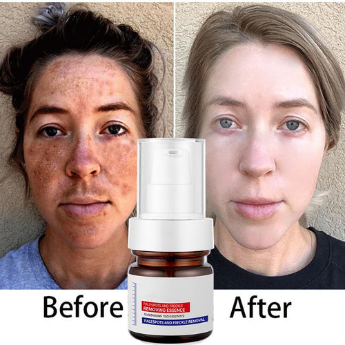 🔥FLASH SALE 50%：5-second brightening rescue: Dark spots disappear, blemishes fade, and skin becomes radiant! Vitamin C Whitening Freckles ESSENCE(3 HOURS LEFT!)