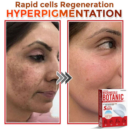 🌈 MicroNeedle Botanic Skin Tag Removal Patch (Made in the USA)