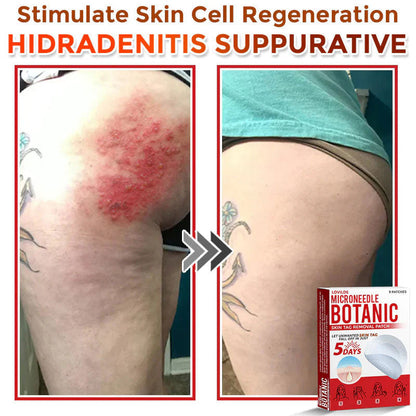 🌈 MicroNeedle Botanic Skin Tag Removal Patch (Made in the USA)