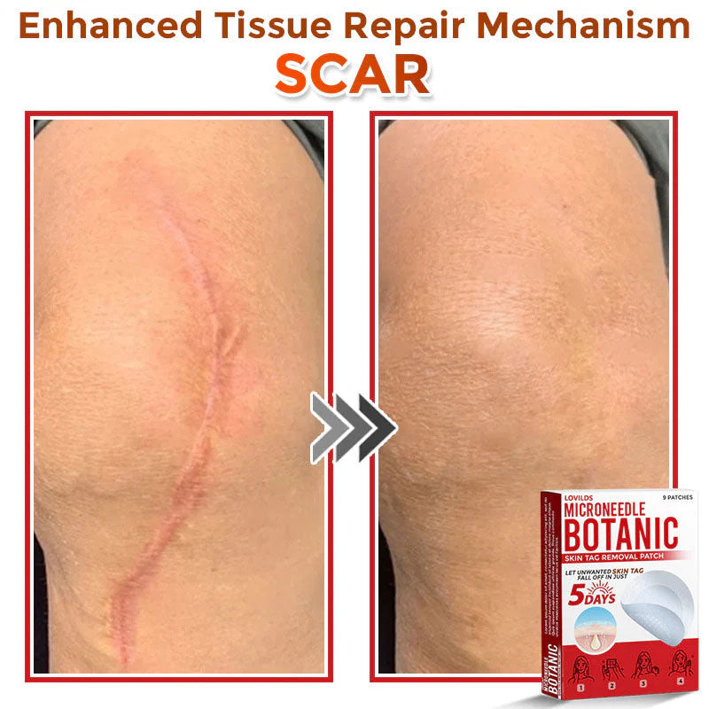 🌈 MicroNeedle Botanic Skin Tag Removal Patch (Made in the USA)